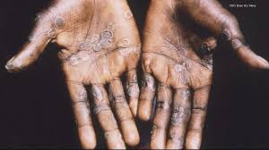 How did the monkeypox outbreak start? Expert shares theory | kvue.com