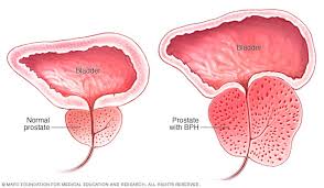 Some things are beyond your control, but you can control the factors that lower your risk and give your body the best tools for fighting illness. Transurethral Resection Of The Prostate Turp Mayo Clinic