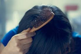 The condition may cause hair to fall out from the head, as well as from other parts of the body. Why Is My Hair Falling Out Causes And Prevention Methods