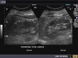 Ultrasound Images Of The Kidneys Reveal Multiple Indentations Short Arrows Of The Renal Cortex Diagnostic Medical Sonography Ultrasound Sonography Ultrasound