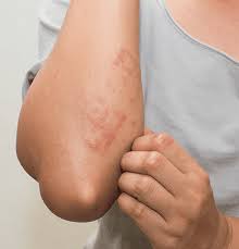 Image result for Rhus Dermatitis