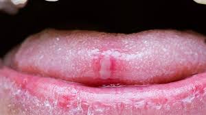 Image result for mouth ulcer on tongue)