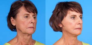 Before And After Sono Bello Total Body Transformation Centers Image Source Sono Bello Website Muscle Body Transformation Body Build Muscle