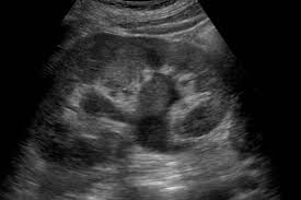 Wk 7 Renal Pathology Pyelonephritis With Thickened Pelvic Wall And Internal Ref Ultrasound Sonography Diagnostic Medical Sonography Vascular Ultrasound