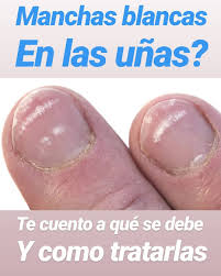 Check spelling or type a new query. Manchas Blancas En Las Unas O Leuconiquia Manchas Las Unas Unas