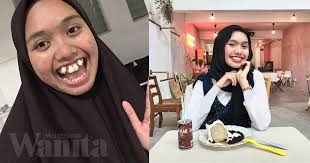 Nama Lain Gadis Ini 'Gigi Salah Parking', Tetapi Selepas Dua Tahun Giginya  Lebih Sempurna