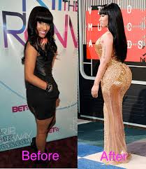 Is There Any Truth Behind Nicki Minaj Plastic Surgery Rumors Read Full Details Here At Https Plentat Com Ni Plastic Surgery Celebs Celebrity Plastic Surgery