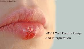 Hsv stands for herpes simplex virus. Hsv 1 Test Results Range And Interpretation Health Checkup