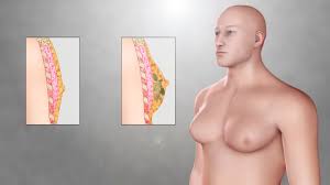 Image result for Gynecomastia