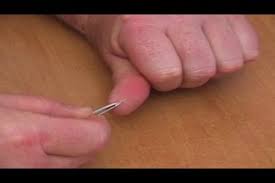 Video So Entfernen Sie Einen Splitter Im Finger