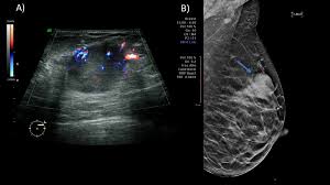 Ultrasound is one of the tools used in breast imaging, but it does not replace annual mammography. Cureus Pregnancy Associated Breast Cancer What Radiologists Must Know