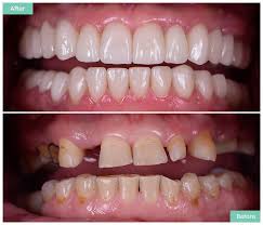 We did not find results for: Dental Implants Cannock Teeth Implant Costs Treatments