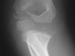 The journal of bone and joint surgery. Lateral Condyle Fracture Pediatric Pediatrics Orthobullets