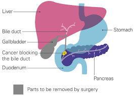 The diagram below depicts the relationship between the liver, pancreas, gallbladder, stomach and duodenum. What Does Bypass Surgery Involve Pancreatic Cancer Uk
