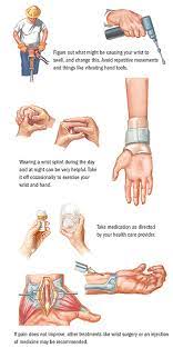 Carpal tunnel syndrome symptoms usually start gradually and include: Carpal Tunnel Syndrome Orthopedics Spectrum Health
