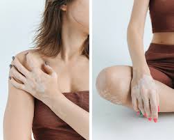 Image result for robert zaruba vitiligo