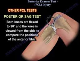 Image result for PCL Sulcus Test
