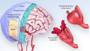 What You Should Know About Cerebral Aneurysms American