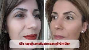 Goz Kapagi Ameliyatimdan Goruntuler Iyilesme Sureci Dr Akin Banaz Youtube