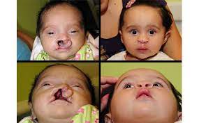 Primary Cleft Lip & Nasal Reconstruction Gallery | St. Louis Children's  Hospital