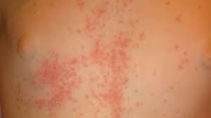 Image result for dermatitis contacta allergica