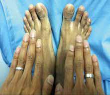 Image result for Clubbing nails feet