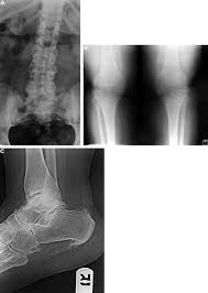 Image result for XRay Changes in Rheumatic Conditions
