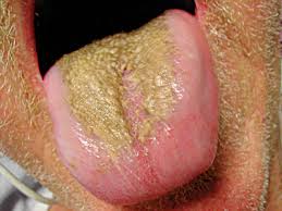 Image result for yellow tongue infection