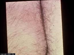 Image result for Ischiorectal Abscess