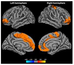 Image result for REM Sleep Behavior Disorder