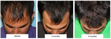 The best men's hair products. Hairline Lowering Vs Hair Transplantation Plastic Surgeon Beverly Hills Ca Dr Jason Champagne