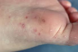 My hands and feet are itchy. Kids Health Information Hand Foot And Mouth Disease