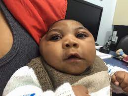 The zika virus arrived in the united states in 2016, with local transmission reported in and around miami, fl, and brownsville, tx. Community Eye Health Journal Zika Infection And The Eye