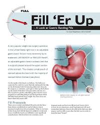 She said hair loss after surgery is due to a person not getting a enough protein so it's very important to get all the protein in post surgery and also there are hormones released when a. Fill Er Up A Look At Gastric Banding Fills Obesity Action Coalition