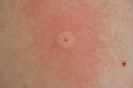 Pin On Bug Bites