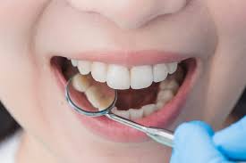Some common indications your wisdom teeth are about to break through. Wisdom Teeth Removal For Teens In Dallas Children S Dental Ortho