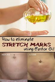 Bio Oil White Stretch Marks Before And After How To Eliminate Stretch Marks Using Castor Oil Diva Secrets Oil For Stretch Marks Stretch Marks Castor Oil