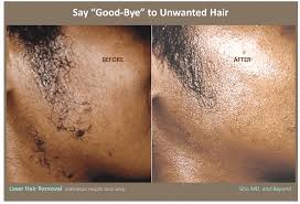 Top 7 laser hair removal devices for dark skin. Laser Hair Removal Plano Tx Frisco Tx