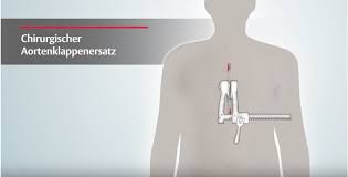 Chirurgischer Aortenklappenersatz Mittels Eines Eingriffs Am Offenen Herzen