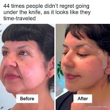 44 times people didn't regret going under the knife, as it looks like they  time-traveled (link in the comments)