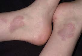 Slideshow What Your Skin Says About Your Health In 2020 Granuloma Annulare Treatment Natural Treatments
