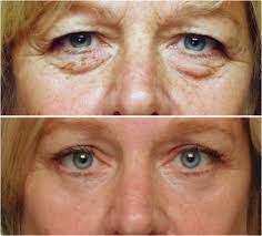 Eyelid Plastic Surgery Beverly Hills Blefaroplastia Apple Cider Shampoo Diy