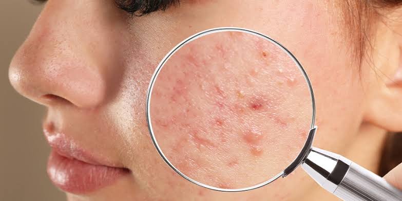 Pimples Treatment In Riyadh & Saudi Arabia