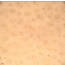 They were firmly attached and great effort was required to remove them. Alopecia Areata Black Dots Are Observed Inside The Yellow Dots And Download Scientific Diagram