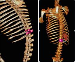 Noticias, videos, transmisiones en vivo y más en t13.cl. Three Dimensional Schematic Pictures Of The T13 Level Of The Spine In Download Scientific Diagram