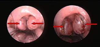 Wann ist eine operation erforderlich? Tonsillotomie