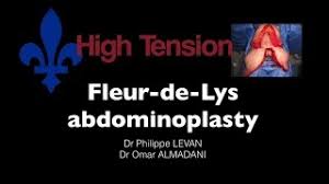 The literature, although limited, supports the effectiveness of this procedure in addressing this clinical scenario. Fleur De Lys Abdominoplasty Youtube