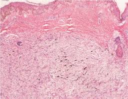 Image result for Dermatofibrosarcoma Protuberans
