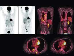 Despite this, pancreatic cancer is among the deadliest types of cancer, which is why it's extremely important to know and recogni. A 71 Year Old Patient With Right Sided Malignant Pleural Mesothelioma Download Scientific Diagram