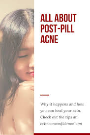 Birth Control Pills That Help With Acne And Weight Loss Post Pill Acne Is One Of The Most Common Side Effects Women Experience When Quitting The Contraceptive Pill Learn How You Contraceptive Pill Acne Skin Healing
